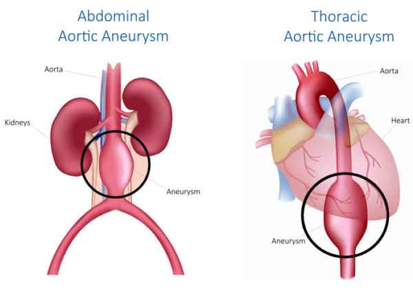 abdominal aortic aneurysm 600x423